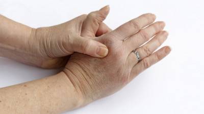 La polyarthrite rhumatoïde